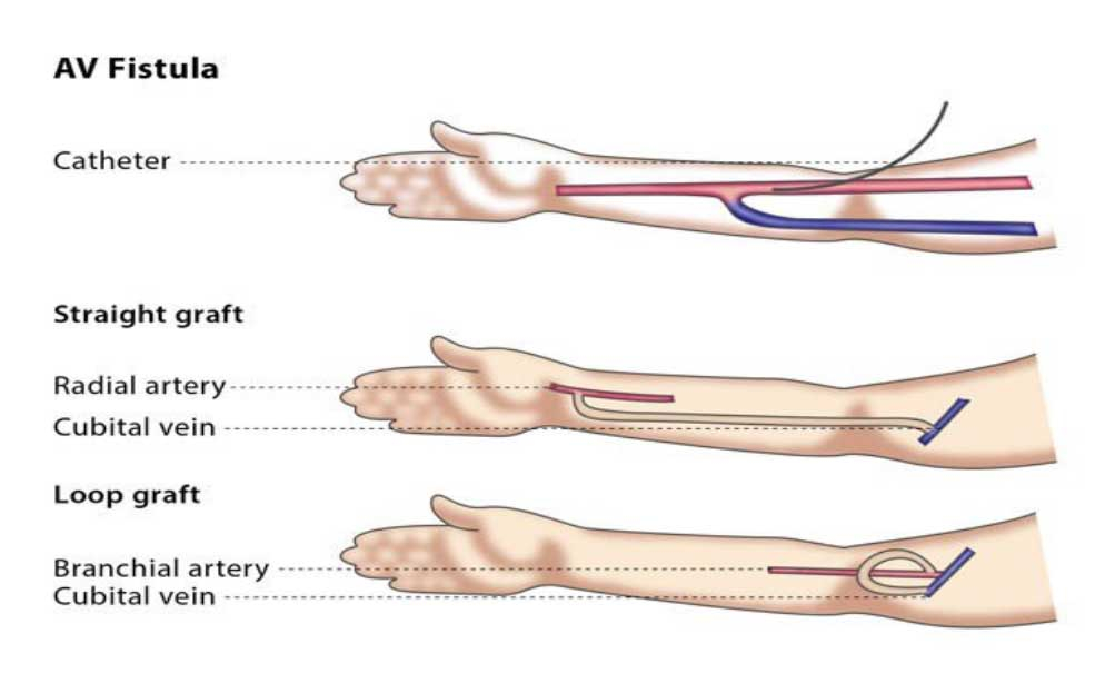 Arterio-Venous Fistula (Avf) Creation For Haemodialysis - Cairns ... throughout